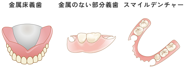 自費の入れ歯